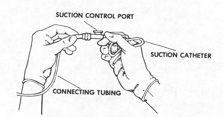 2 39 PERFORMING TRACHEOSTOMY SUCTIONING